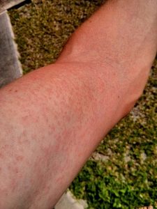 Zika.Virus.Rash.Arm.2014